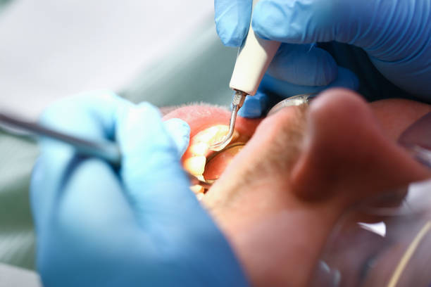 Best Emergency Tooth Extraction in Albany, TX